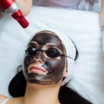 The Best Age to Start Laser Carbon Peel Treatments