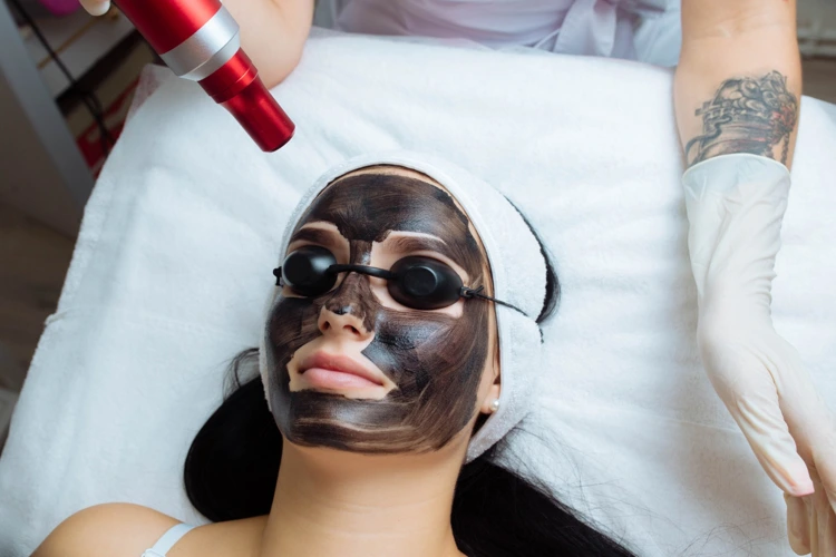 The Best Age to Start Laser Carbon Peel Treatments