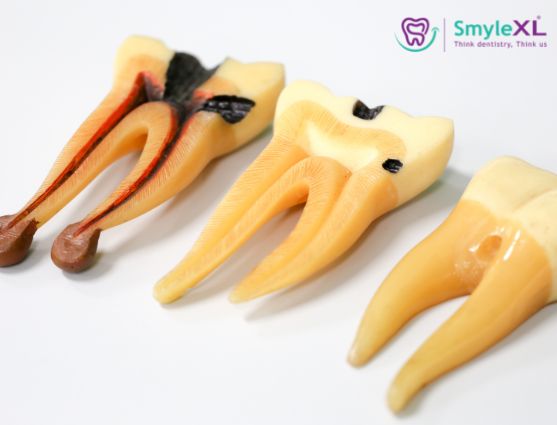Tooth Pain? Know the RCT Cost Before Treatmen