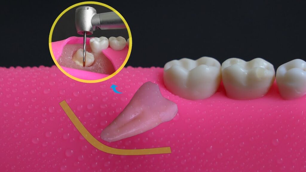 What Is The Recovery Time After Wisdom Teeth Removal?