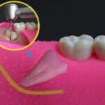 What Is The Recovery Time After Wisdom Teeth Removal?