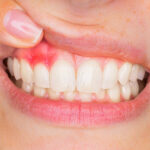 Best Gum Disease Treatment in Solapur | Expert Dental Care