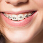 What You Can and Can’t Eat With Braces