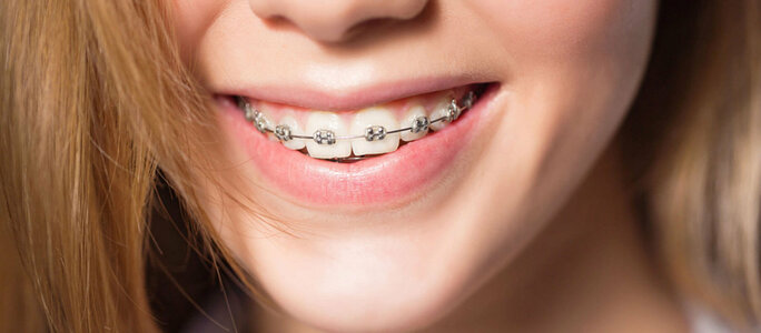 What You Can and Can’t Eat With Braces