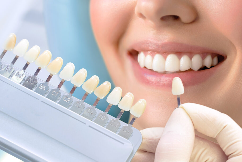 Understanding the Long-Term Benefits of Dental Veneers in Parel Mumbai