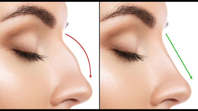 Rhinoplasty in Dubai for Nose Reshaping and Facial Harmony Enhancement