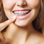 How Do Braces Actually Work?