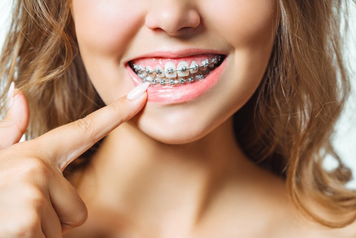 How Do Braces Actually Work?