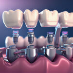 Dental Implants: The Ultimate Solution To Replace Loose & Missing Teeth