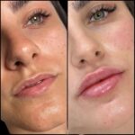 Fillers in Dubai for Natural-Looking Facial Rejuvenation