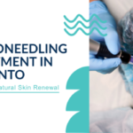Microneedling Treatment in Toronto: Unlocking Natural Skin Renewal