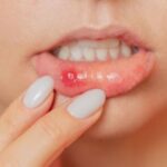 Effective Relief for Recurring Oral Sores with a Trusted Mouth Ulcers Specialist in Surat