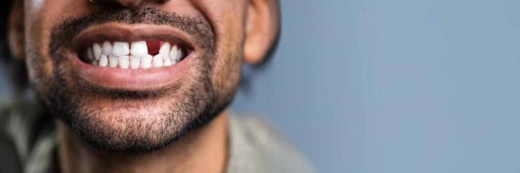 Missing Teeth for Years? Here’s How Dental Implants Can Still Help