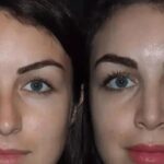 Rhinoplasty in Dubai by Experienced Cosmetic Specialists