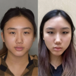 Face Slimming Secrets Behind Buccal fat removal Surgery in Dubai
