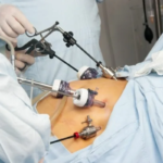 Myomectomy: Types, Benefits, Risks, Recovery, and How It Compares to Uterine Fibroid Embolization