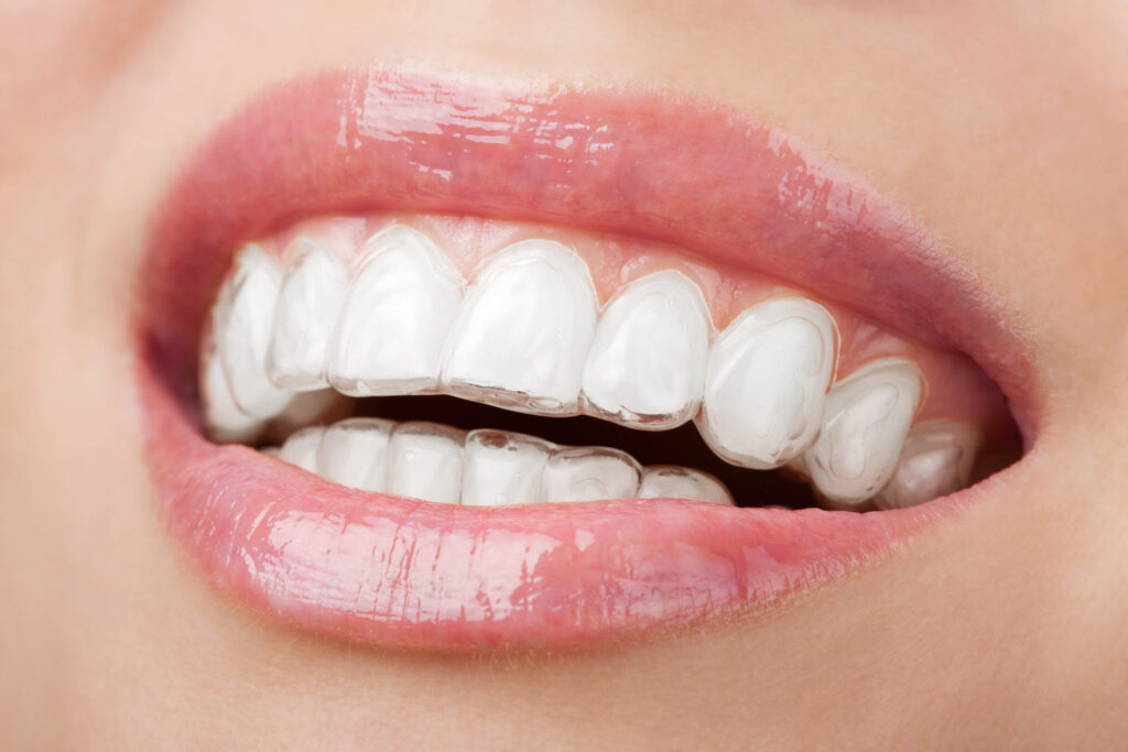 Adult Orthodontics – Why More Adults Are Getting Braces