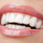 Adult Orthodontics – Why More Adults Are Getting Braces