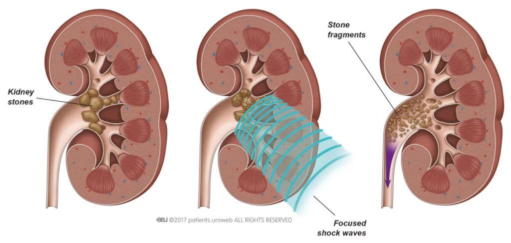 Benefits of Shock Wave Lithotripsy for Kidney Stones