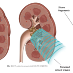 Benefits of Shock Wave Lithotripsy for Kidney Stones