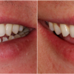 Benefits of Porcelain Veneers for a Perfect Smile