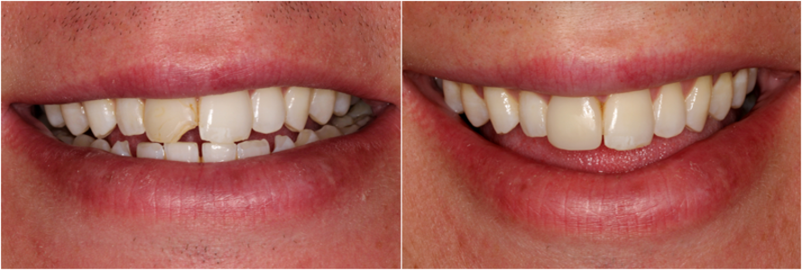 Benefits of Porcelain Veneers for a Perfect Smile