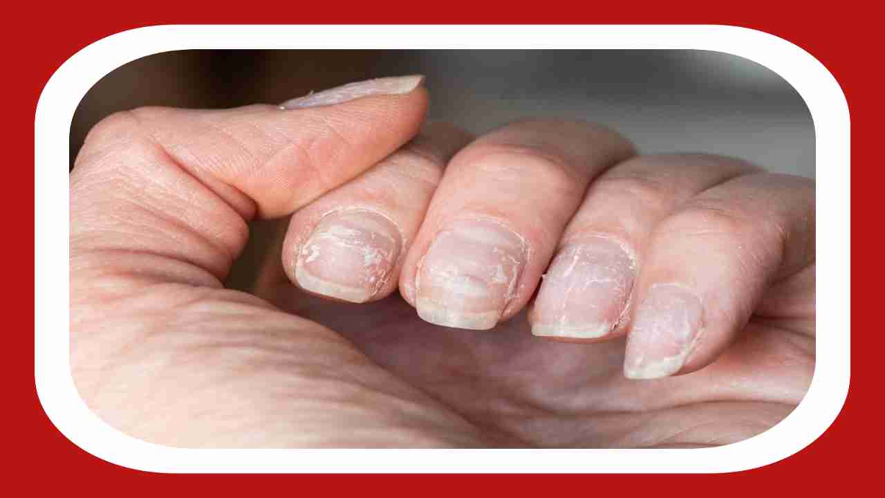 Brittle Nails : మన గోళ్లు పెళుసుగా ఎందుకు మారతాయి ? సమస్యను ఎలా పరిష్కరించాలి.