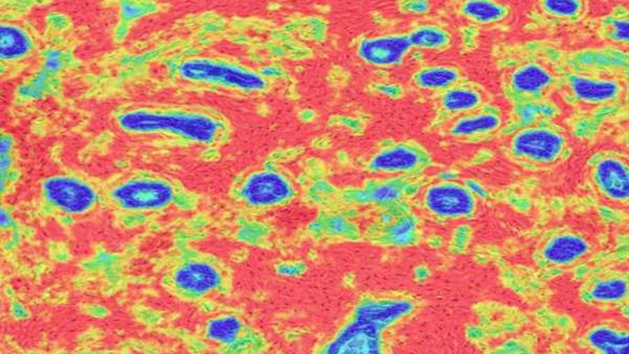 U.S. researchers identify tissue changes linked to aggressive breast cancer risk