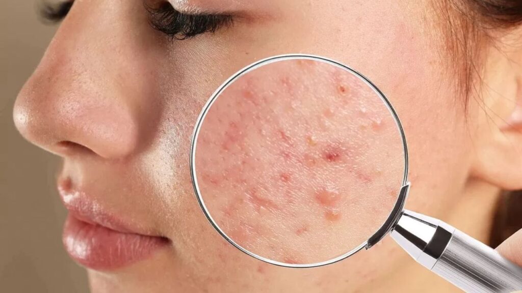 Home remdies may help to reduce pimples