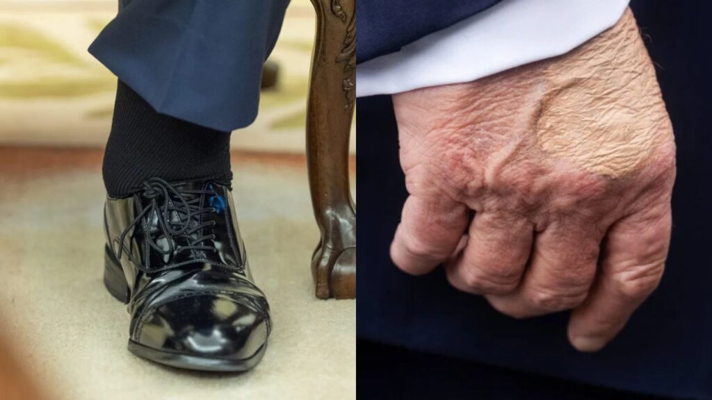 Trump's swollen ankle and hands (Source: Internet)