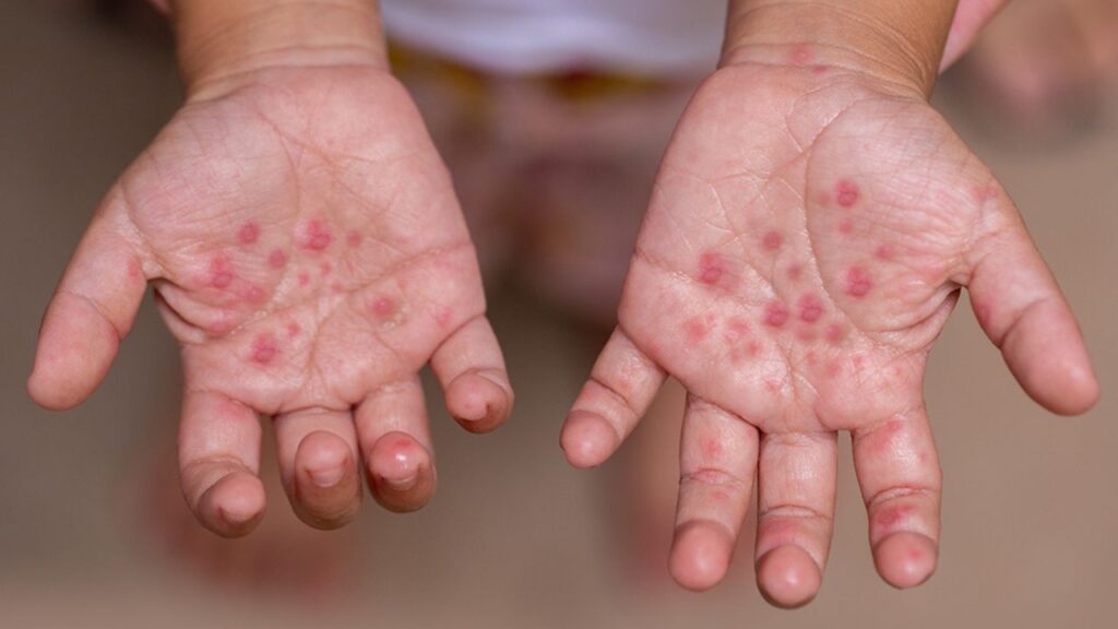 HFMS virus is attacking children in many districts of Delhi and UP
