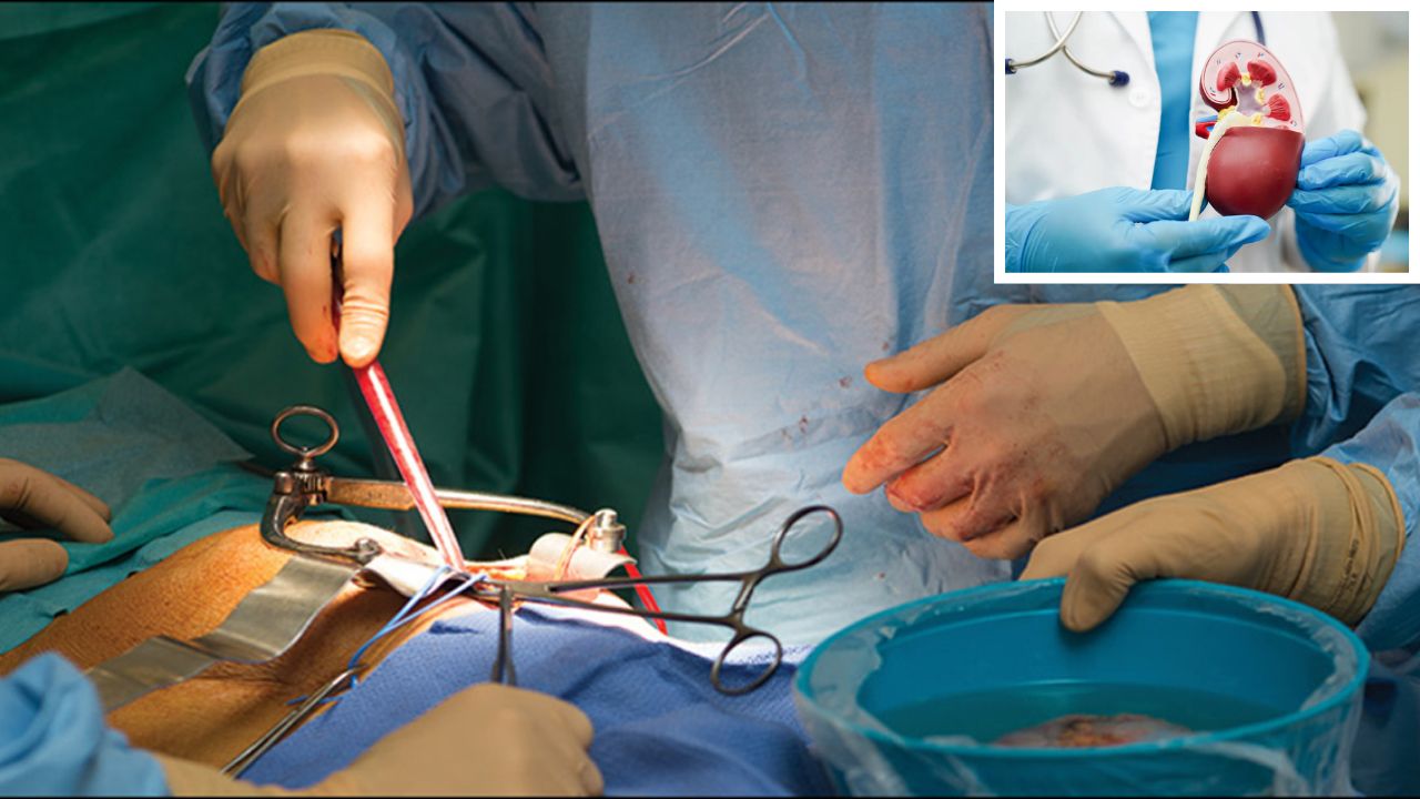 How long can someone live after a kidney transplant? All you need to know