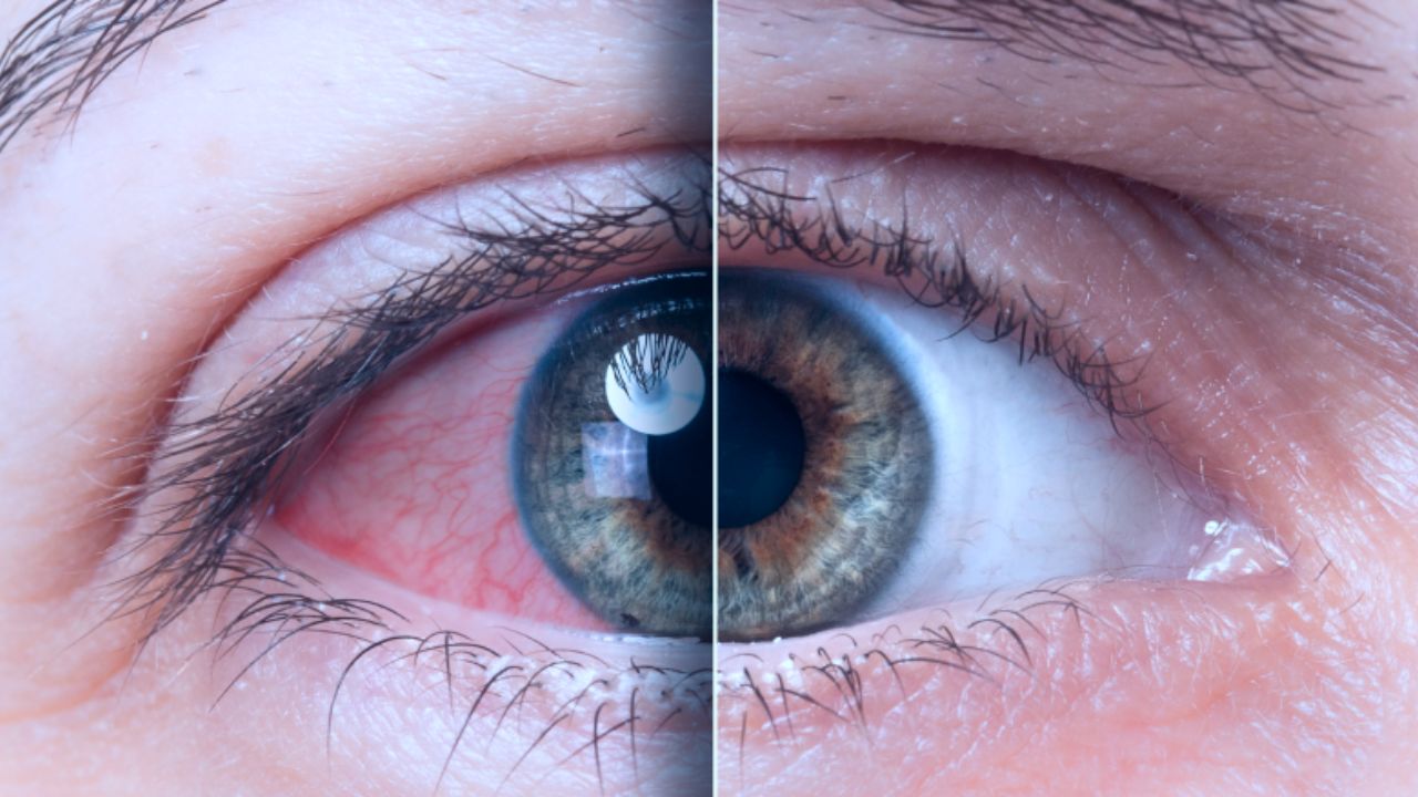 Are you at risk? How to detect glaucoma before it’s too late