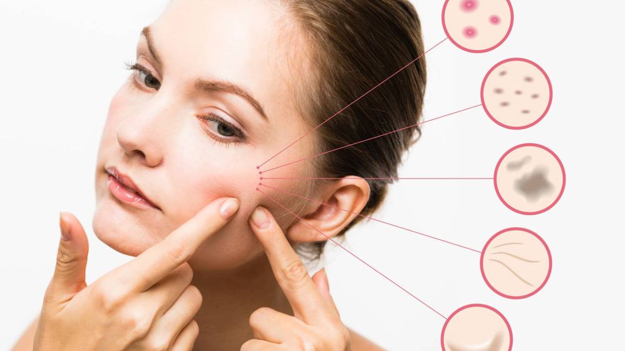 Winter Breakouts: How cold air and smog are triggering more acne; Explained