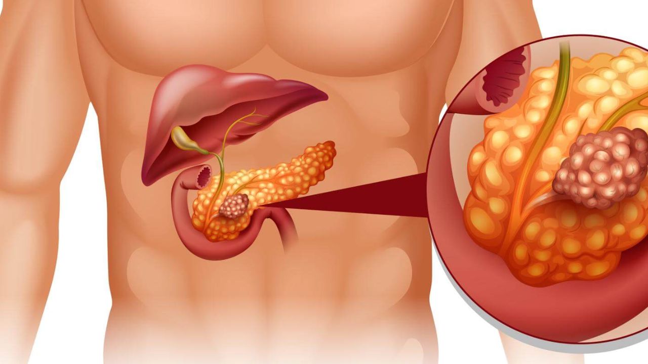 Pancreatic cancer
