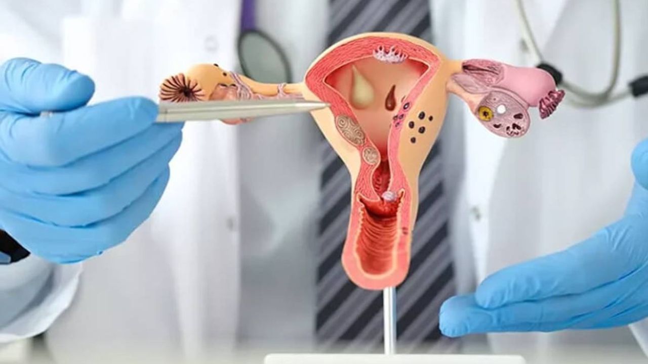 PCOS on rise among young women due to these 3 everyday habits