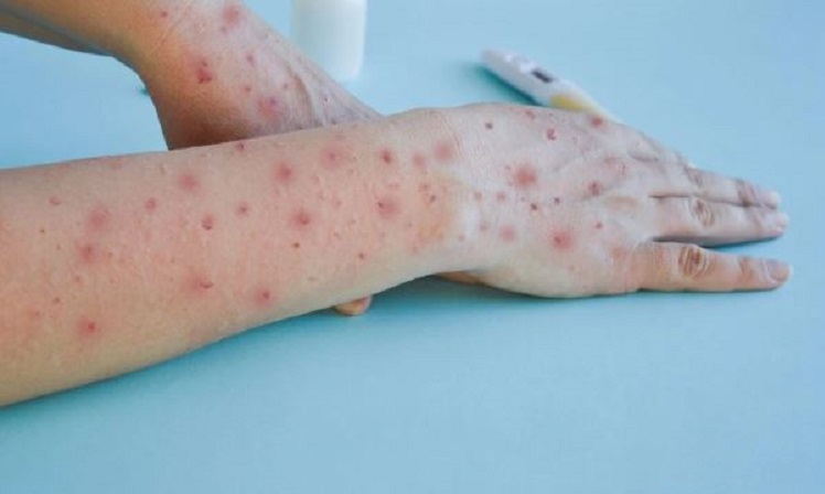Monkeypox: भारत में मिला पहला Mpox का केस, स्वास्थ्य विभाग अलर्ट