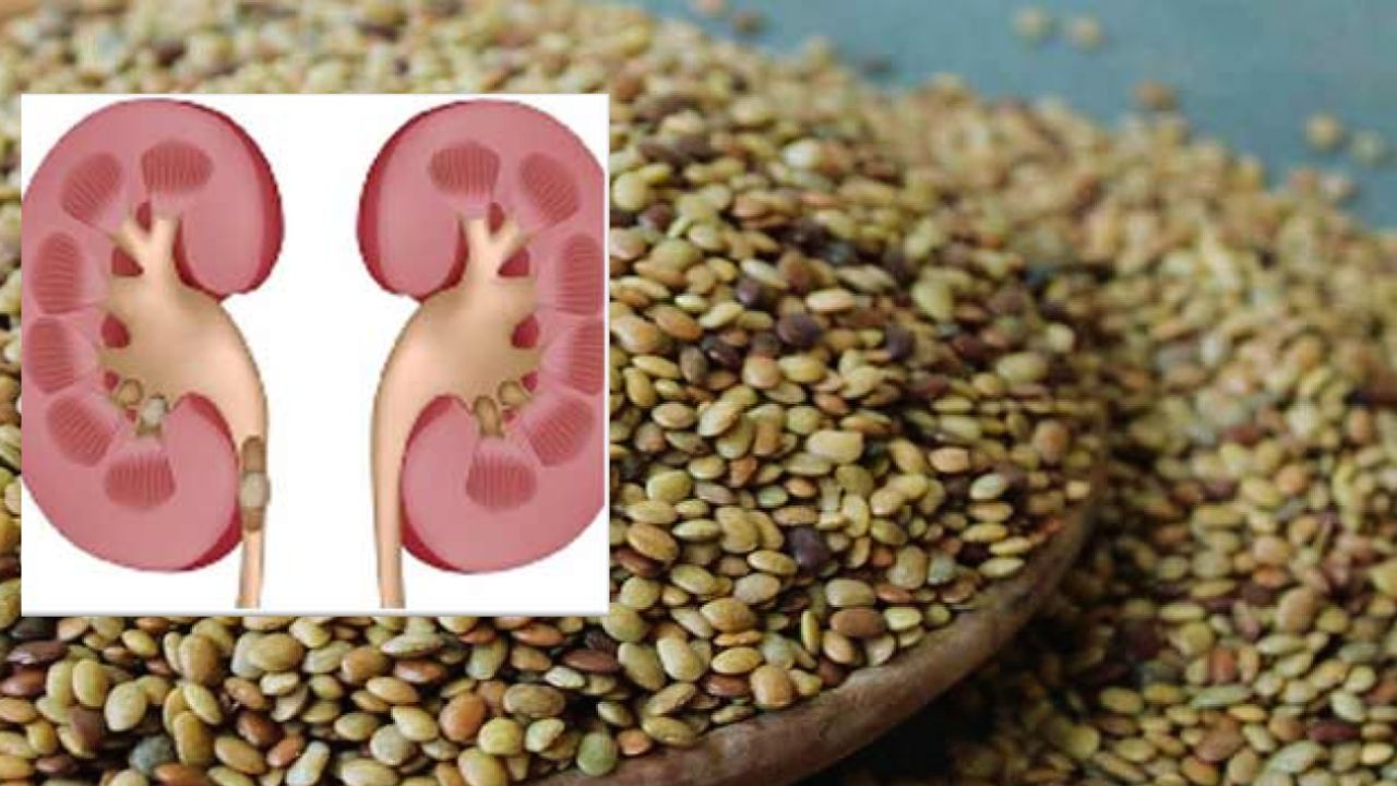 Uttarakhand: पथरी के इलाज पर आया नया शोध, जानिए इस दाल में छुपा है इसका अचूक इलाज