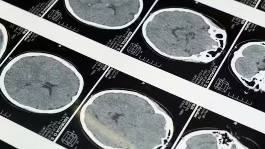 Alzheimers Womens Health