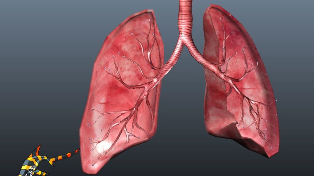 Lung Rupture 