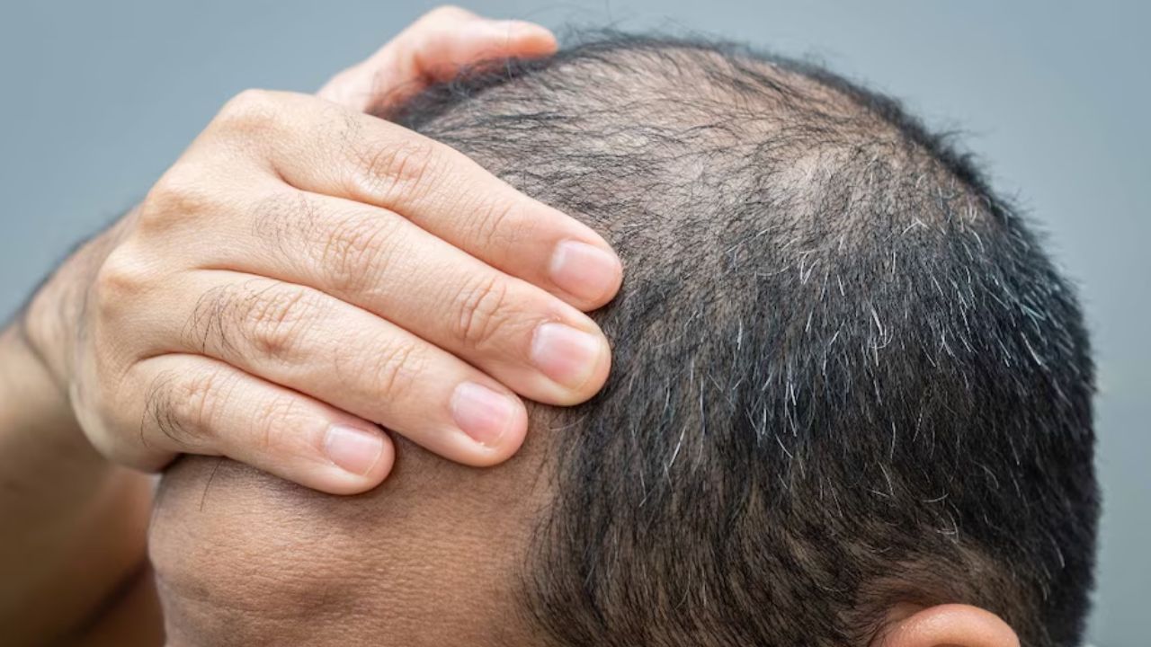 पति निकला गंजा तो बीवी ने करवाई एफआईआर, नोएडा पुलिस बोली- मामला गंभीर है