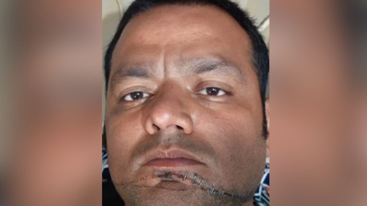 Gorakhpur News: चाइनीज मांझे की चपेट में आया बाइक सवार, गाल पर लगे 8 टांके