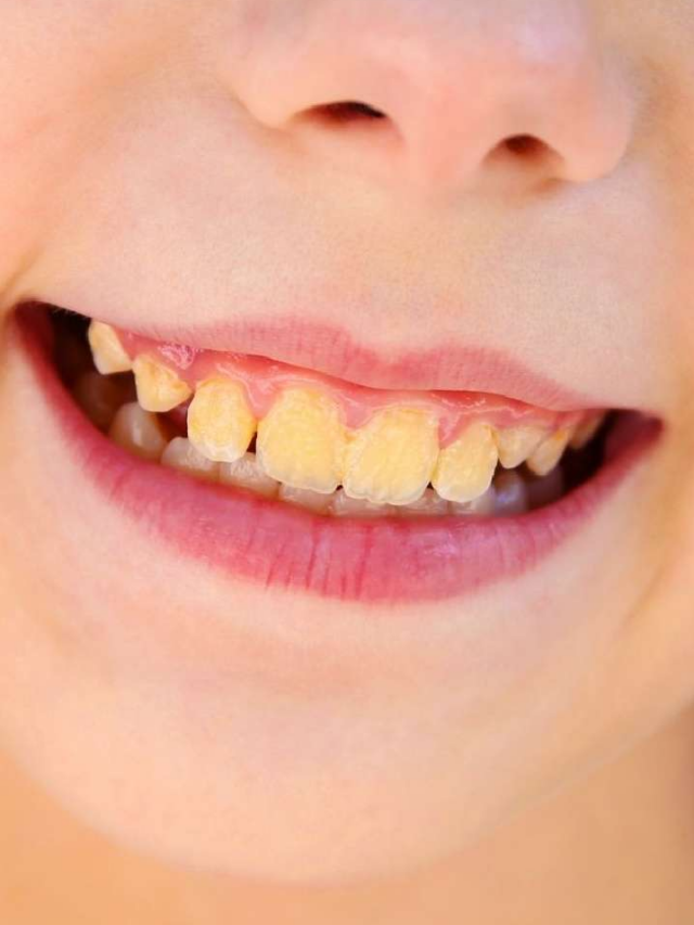 दांतों का पीलापन हटाने के आसान देसी उपाय