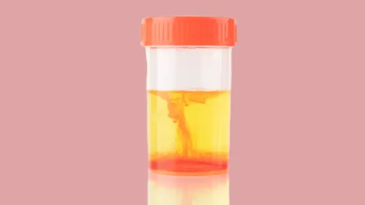 मेडिकल भाषा में पेशाब में खून आने की स्थिति को हेमैच्यूरिया कहा जाता है। यह तब होता है जब किडनी, यूरिनरी ट्रैक्ट या ब्लैडर से रेड ब्लड सेल्स यूरिन में आ जाते हैं। यह दो प्रकार का होता है एक जिसमें खून साफ दिखाई देता है और दूसरा जो केवल टेस्ट के जरिए ही पता चलता है। (Img- Google)