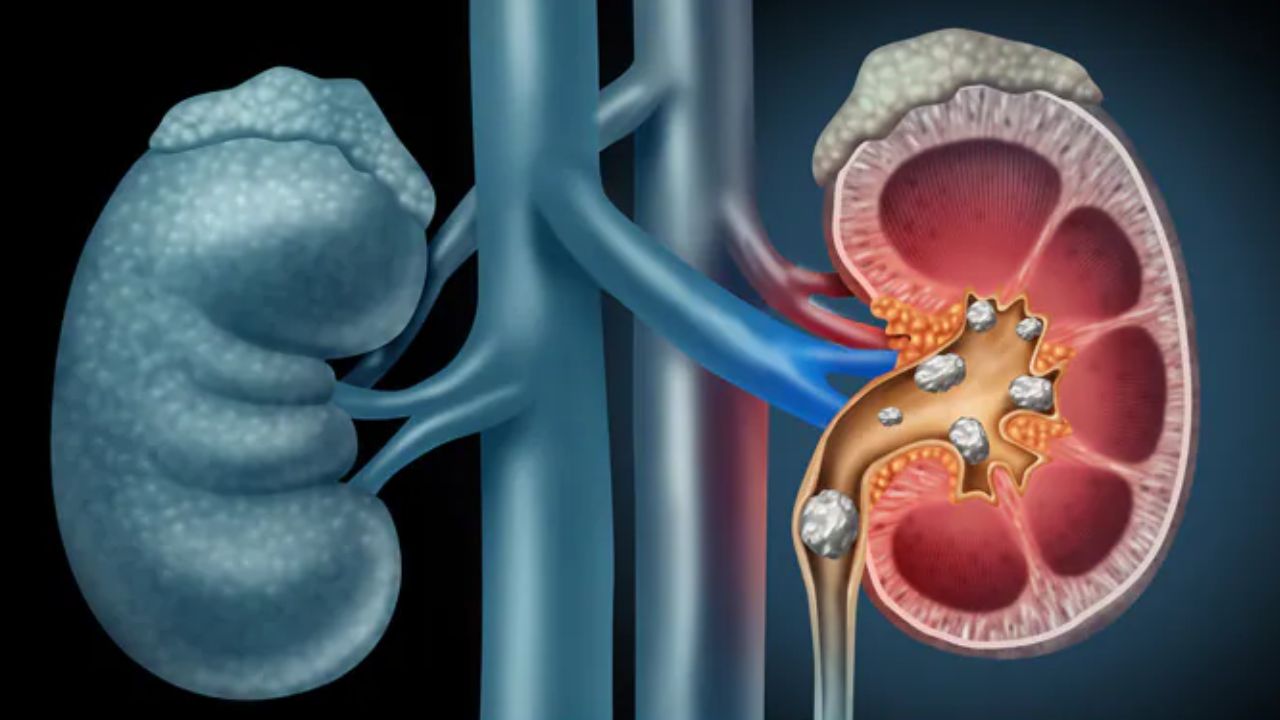 हालांकि, हर बार पेशाब में खून आने का मतलब कैंसर नहीं होता। इसके पीछे कई सामान्य कारण भी हो सकते हैं जैसे किडनी स्टोन, यूरिन इन्फेक्शन, प्रोस्टेट का बढ़ना या किडनी से जुड़ी अन्य समस्याएं। फिर भी अगर यह समस्या बार-बार हो या बिना दर्द के हो, तो डॉक्टर से सलाह लेना जरूरी है। (Img- Google)