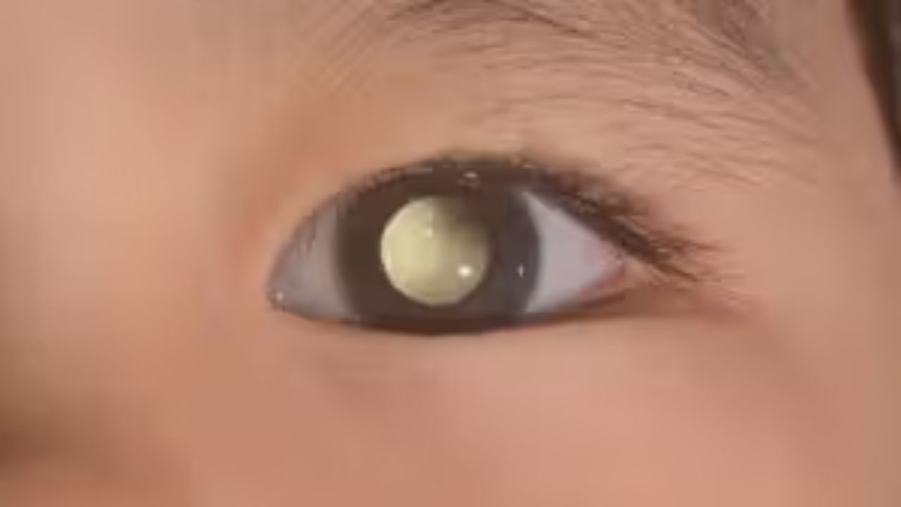 सावधान! कहीं आपके बच्चे की आँखें बिल्ली की तरह तो नहीं चमकती