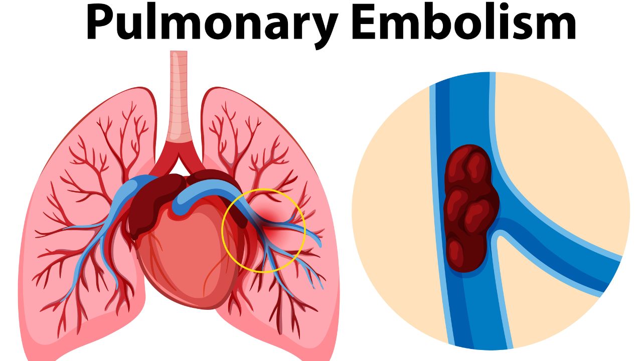 क्या है Pulmonary Embolism? प्रतीक यादव की मौत के बाद चर्चा में आई जानलेवा बीमारी, इन लक्षणों को न करें नजरअंदाज