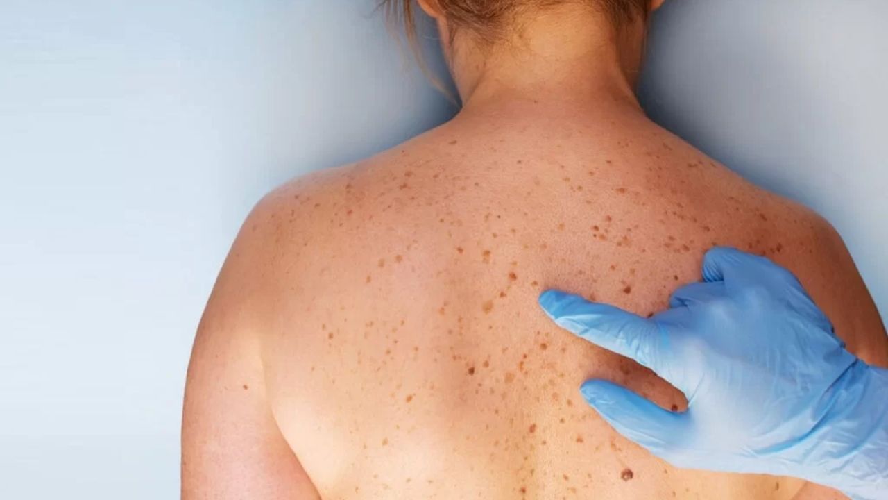 Skin Cancer: स्किन कैंसर का यह खतरनाक रूप चुपके से बना रहा है शिकार, जानिए त्वचा का कौन सा बदलाव है मौत का संकेत