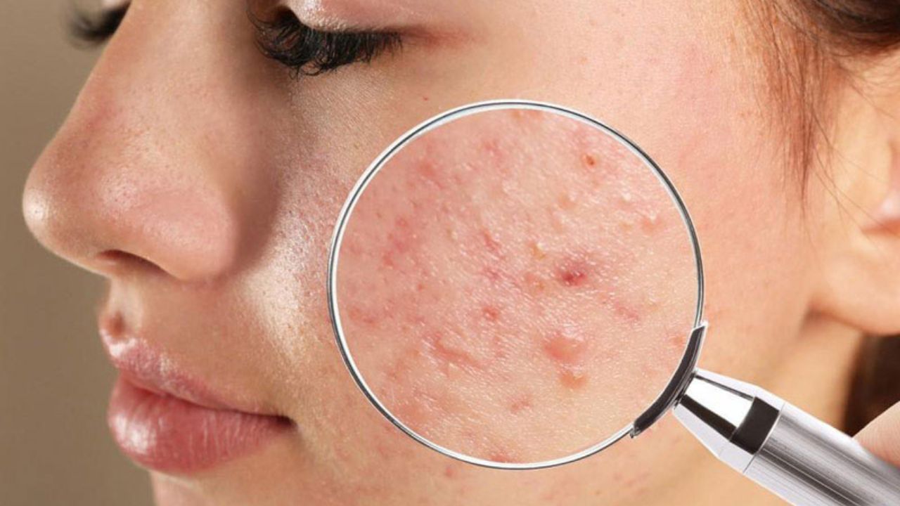 केमिकल नहीं आयुर्वेद से मिटेंगे Acne: जानें Pimples होने की असली वजह और दो जादुई फेस पैक बनाने का तरीका