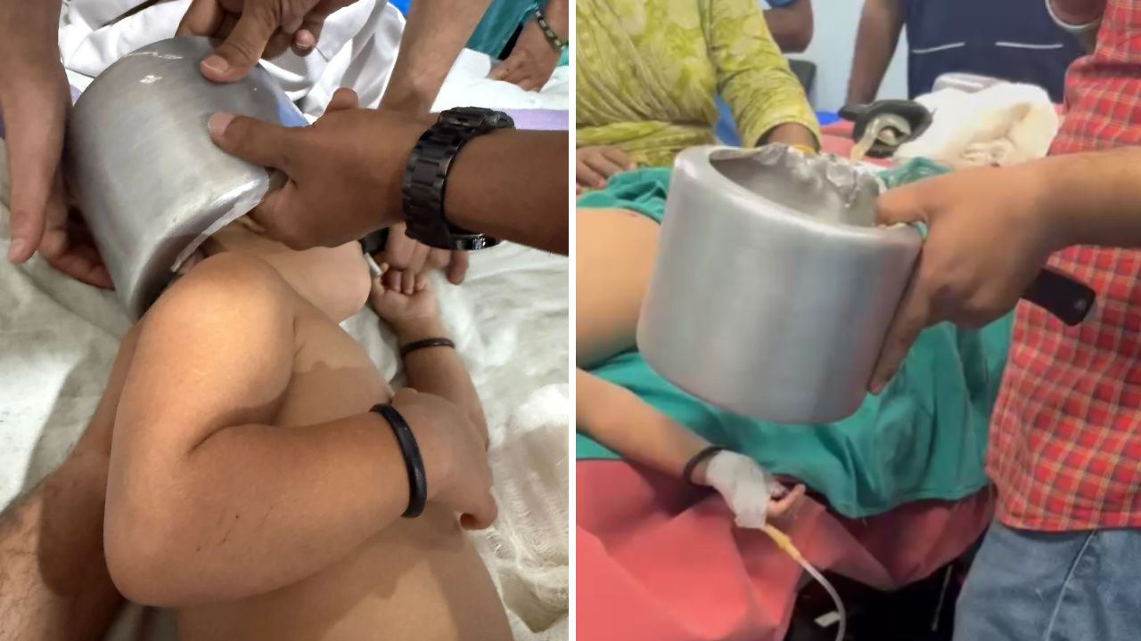 डॉक्टर साहब मेरी बच्ची को बचा लो, चंदौली में खेलते-खेलते 2 साल की मासूम के सिर में फंसा प्रेशर कुकर, जानिए कैसे निकाला बाहर